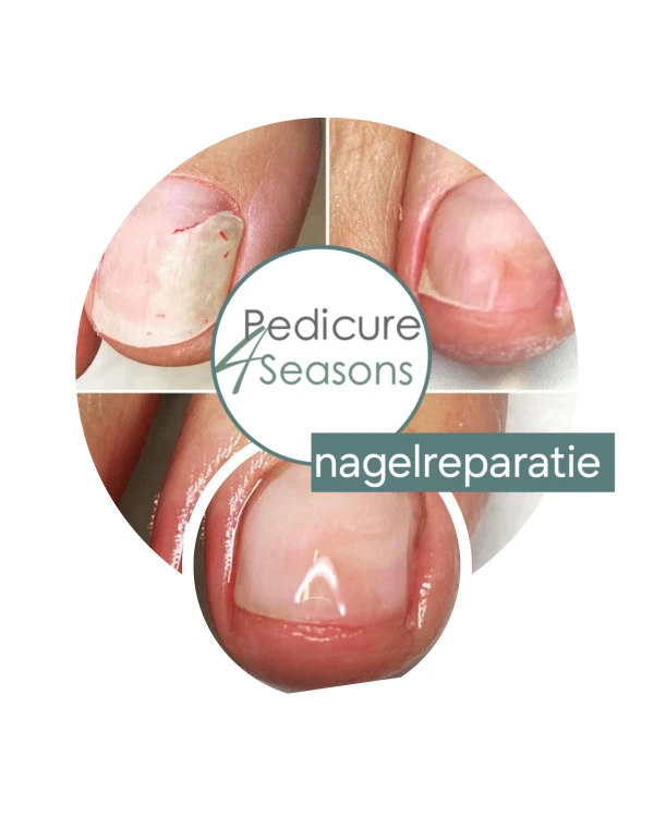 ingroeiende teennagel